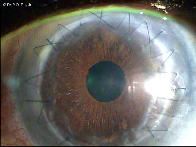 dr-roy-coosa-eye-Corneal Transplant