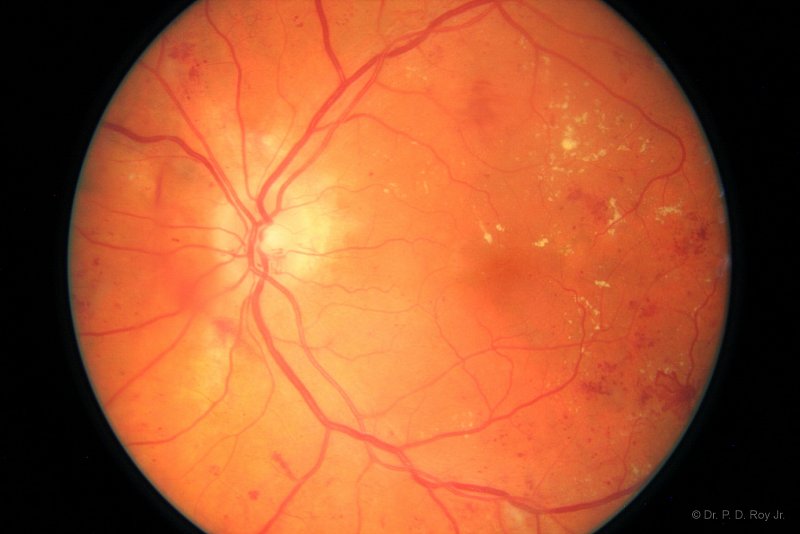 dr-roy-coosa-eye-Diabetic Retinopathy
