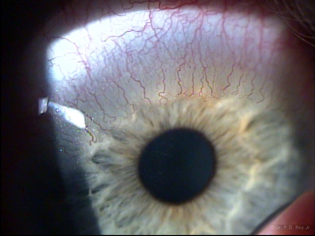 dr-roy-coosa-eye-Neovascularization
