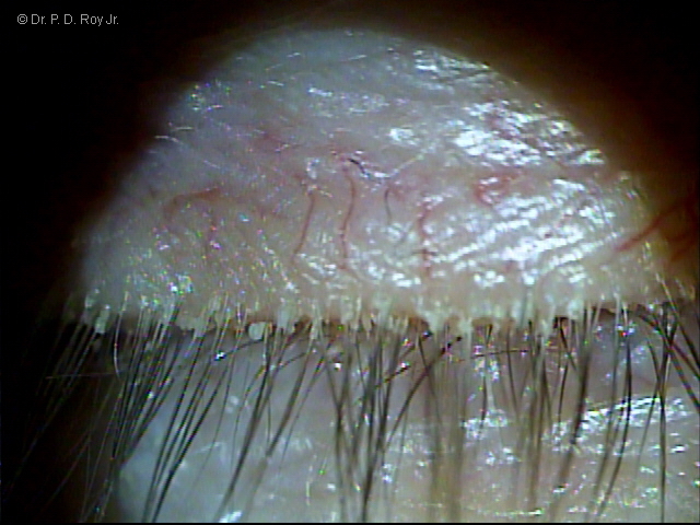 dr-roy-coosa-eye-Blepharitis2