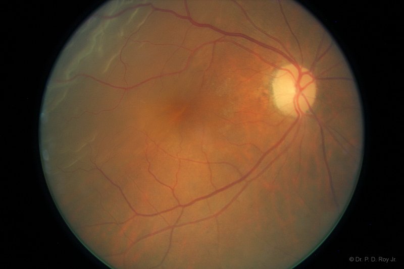 Dr-Roy-Coosa-Eye-Retina Detachment Repaired