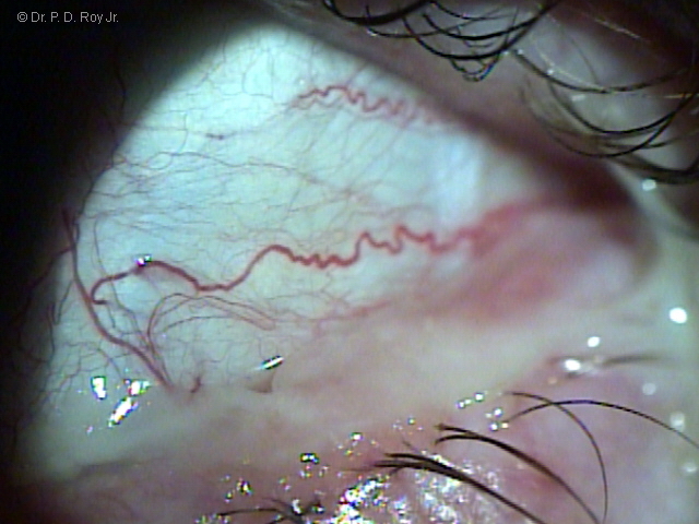 dr-roy-coosa-eye-Bacterial-conjunctivitis