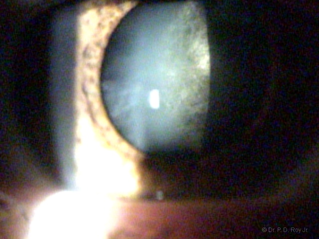 Dr-Roy-Coosa-Eye-Cataract-Before-Removal-OD