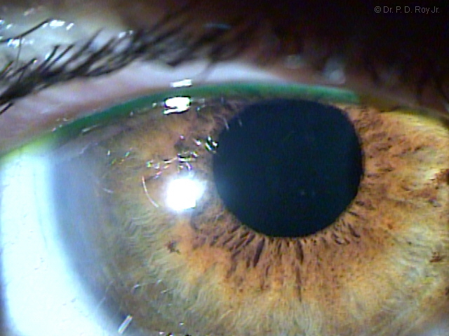 Dr-Roy-Coosa-Eye-Cataract-Intraocular-Lens -Behind-Undilated-Pupil-OD-2